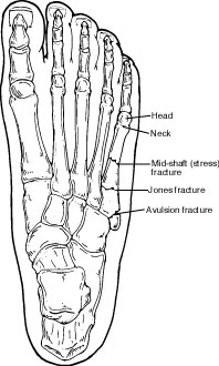 broken meta tarsal treatment options