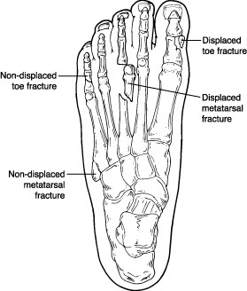 fractured toe treatment