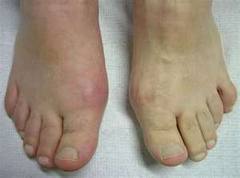 Holiday Season May Trigger Painful Toe Joints