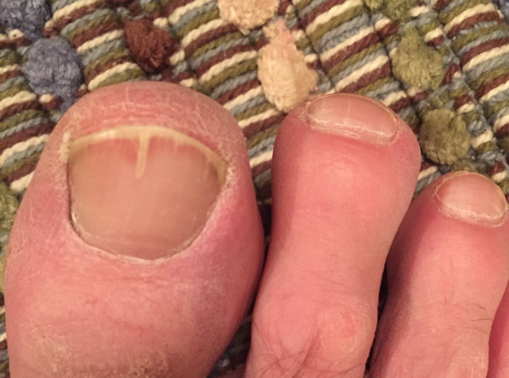 Toenail Fungus